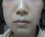 抜歯で目が腫れる 気まぐれ歳時記 抜歯で目が腫れる 気まぐれ歳時記